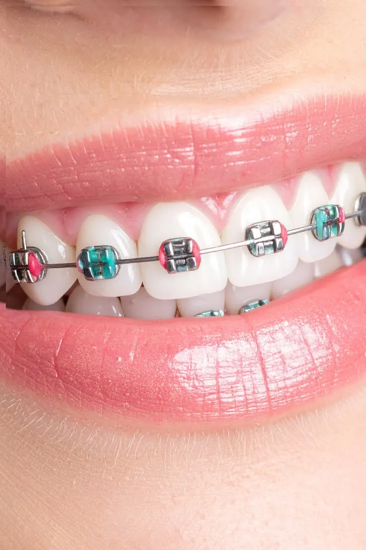 Aparat dentar cu elastice colorate